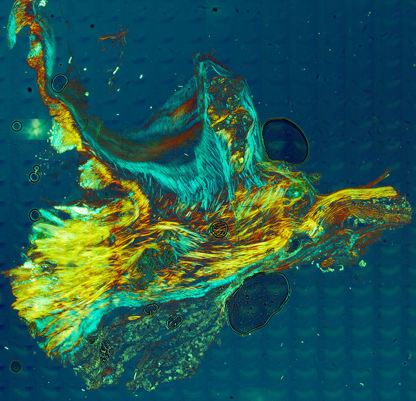 Partially calcified valve leaflet tissue