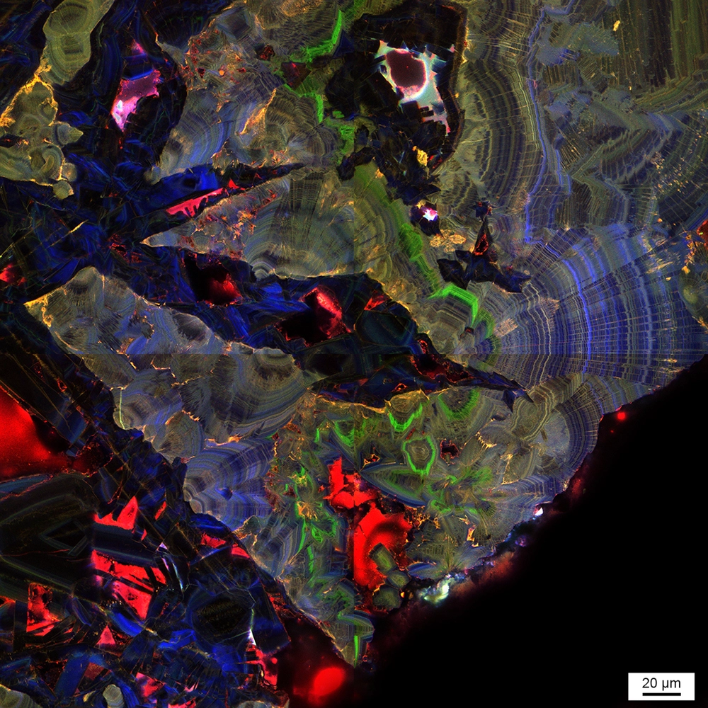 kidney stone A fluorescence micrograph of a human kidney stone