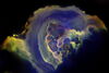 Ductal carcinoma in situ.